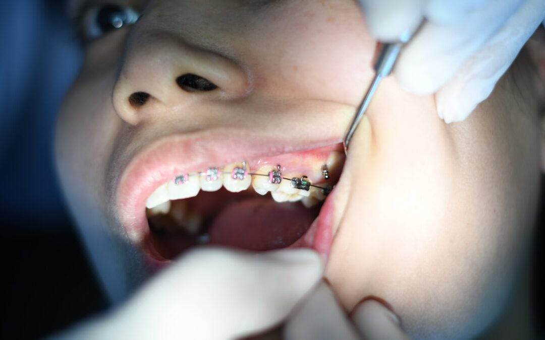 close up of braces
