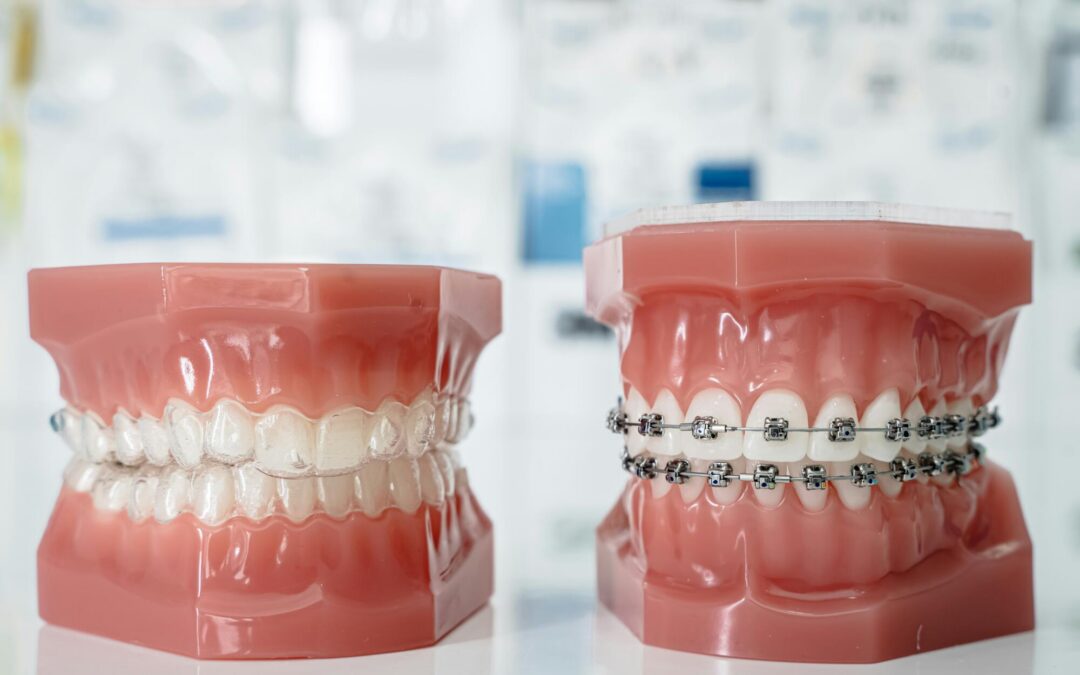 how do braces work