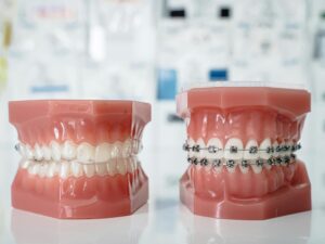 how do braces work